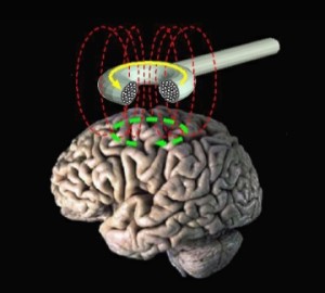 Transcranial Magnetic Brain Stimulation